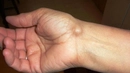 Ganglion Kisti Belirtileri ve Tedavisi Ganglion Kisti Belirtileri ve Tedavisi