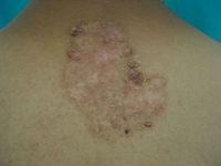 Lenfanjiom Belirtileri ve Tedavisi Lenfanjiom Belirtileri ve Tedavisi