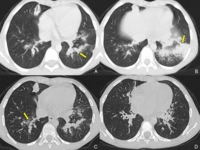 Anekoik Kist Tedavisi Anekoik Kist Tedavisi