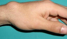 Kist Neden Olur? Kist Neden Olur?