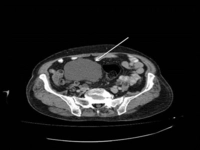 Sağ Overde Kist Belirtileri ve Tedavisi Sağ Overde Kist Belirtileri ve Tedavisi