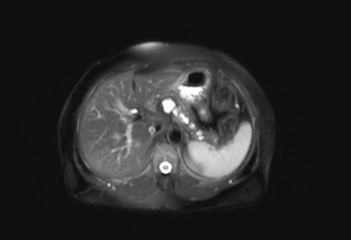 Komplike Kist Belirtileri ve Tedavisi Komplike Kist Belirtileri ve Tedavisi