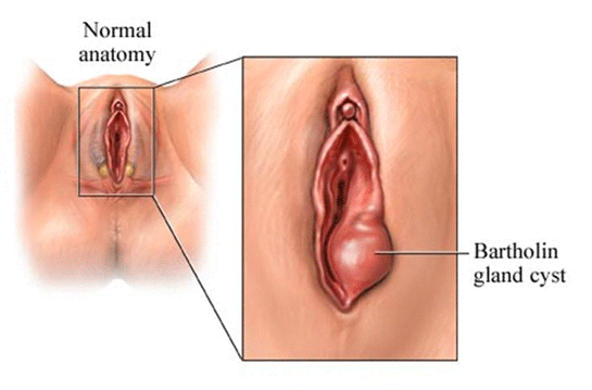 Bartholin Kisti Ameliyat