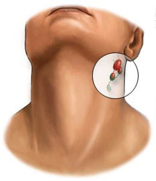 Boyunda Kist Belirtileri ve Tedavisi