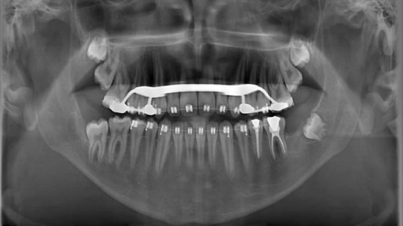 Diş Eti Kisti Ameliyatı
