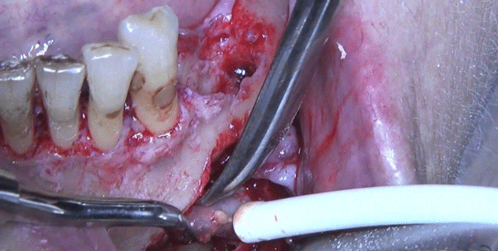 Diş Kisti Ameliyatı
