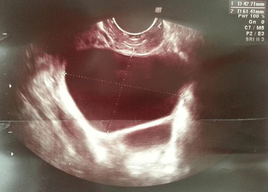 Hamilelikte Kist Patlaması