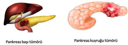 Pankreasta Kist