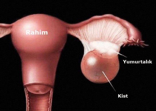 Rahimdeki Kist Belirtileri